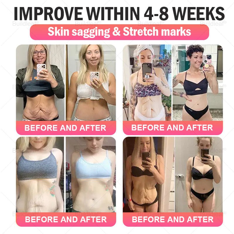 FDA Store | 𝐵uil𝗱𝐿ea𝐟® 𝐆𝐋𝐏-𝟏 Support 𝑁ano 𝑀icroneedle 𝑃atch with Collagen & Matrixyl 3000 丨Obesity,Cardiovascular Diseas, Diabetes, Sleep Apnea, Joint Problems and More